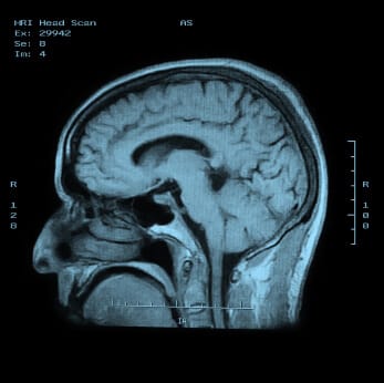MRI head scans