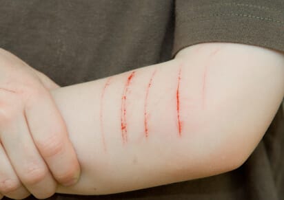 closeup on the arms of a young person with cutting marks